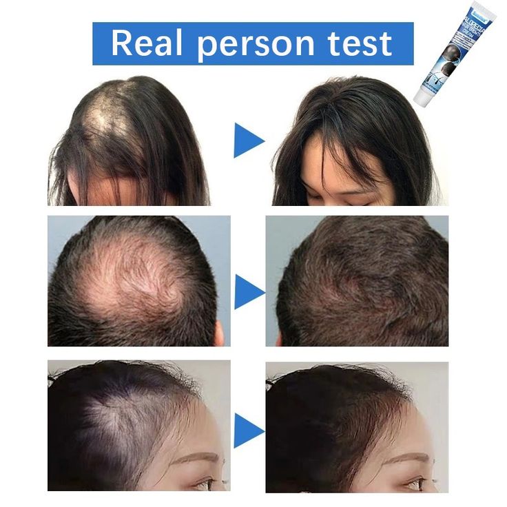 Sumifun Hair Growth Cream (Original) Natural Treatment for Hairloss & Regrowth